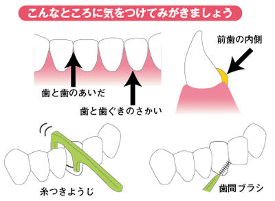 こんなところに気をつけてみがきましょう
