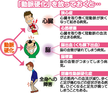 どうして「動脈硬化」になるの?