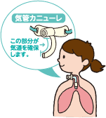 気管切開